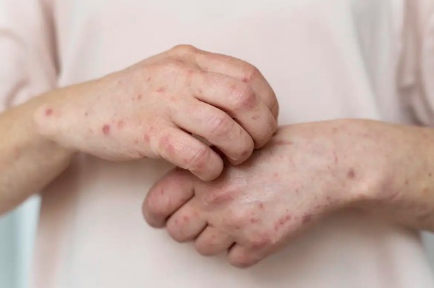 dia-mundial-do-lupus:-especialistas-alertam-para-sintomas-da-doenca-autoimune